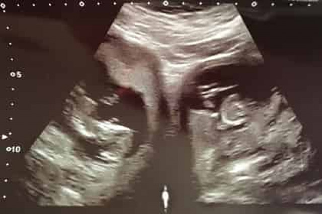 Женщина с двумя матками родила двух детей