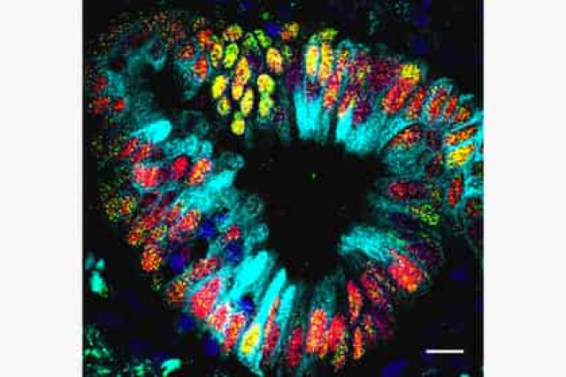 Внутри рака легких нашли недоразвитый организм