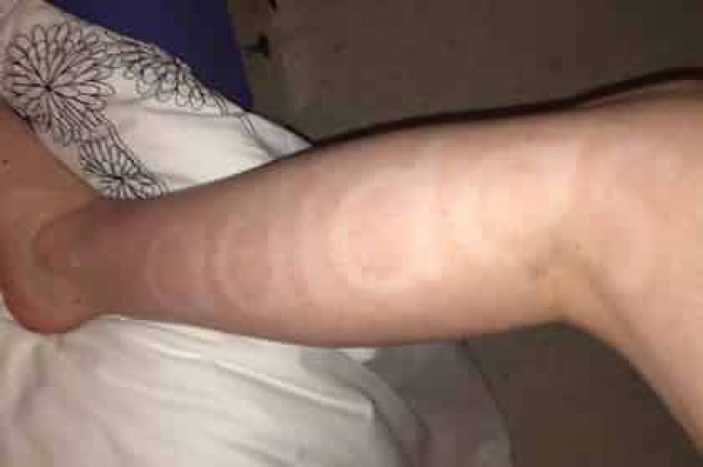 На теле злоупотреблявшей спортом и автозагаром женщины проступил логотип Adidas