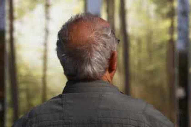 Ученые установили связь между облысением и опасными заболеваниями