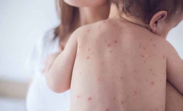 Measles cases rise 30% worldwide: UN