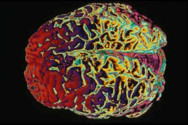 Создана разрушающая человеческий мозг молекула-убийца
