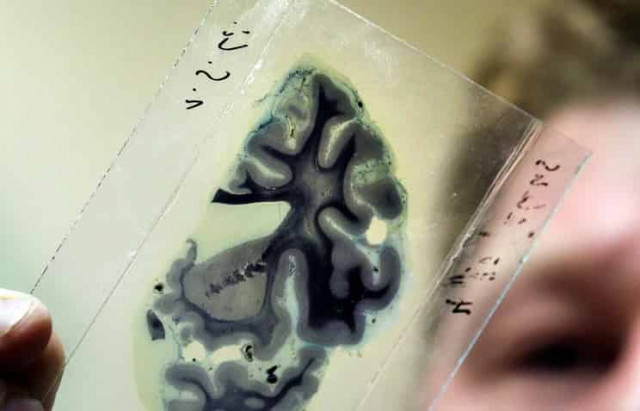 Израильские ученые разработали препарат, устраняющий симптомы болезни Альцгеймера