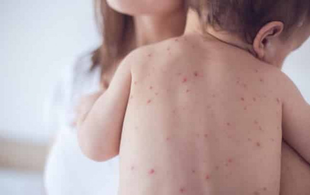 Минздрав предупредил о новой вспышке заболевания корью в Украине