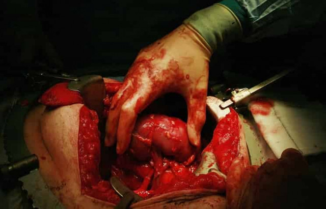 СМИ: ученые из США разработали метод, расширяющий возможности пересадки почки