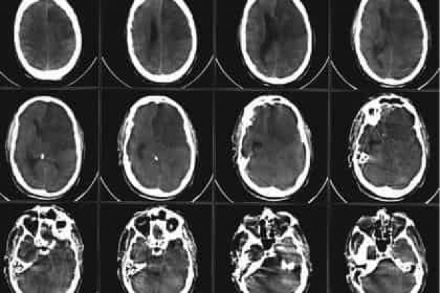 Впервые открыт механизм восстановления нервных клеток после инсульта