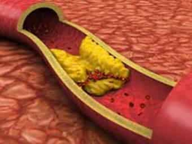 Хроническое воспаление десен ведет к атеросклерозу