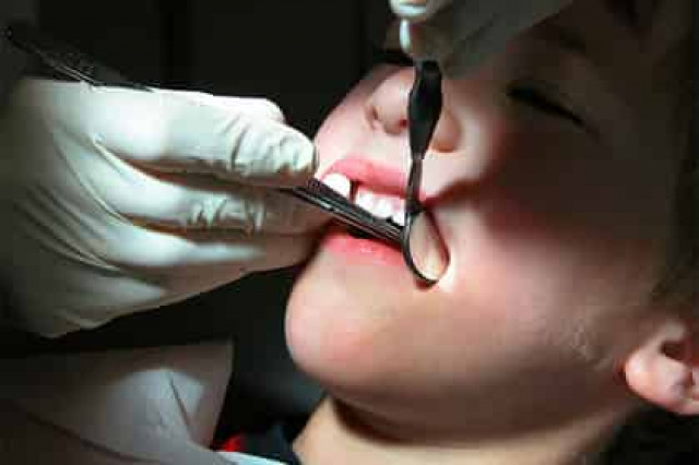 Создана эффективная вакцина от кариеса