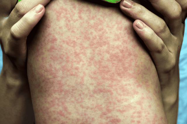 Over 57,000 measles cases recorded in Ukraine since year-start
