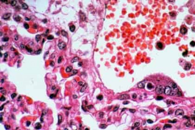 Зарегистрирована смертельно опасная для человечества инфекция
