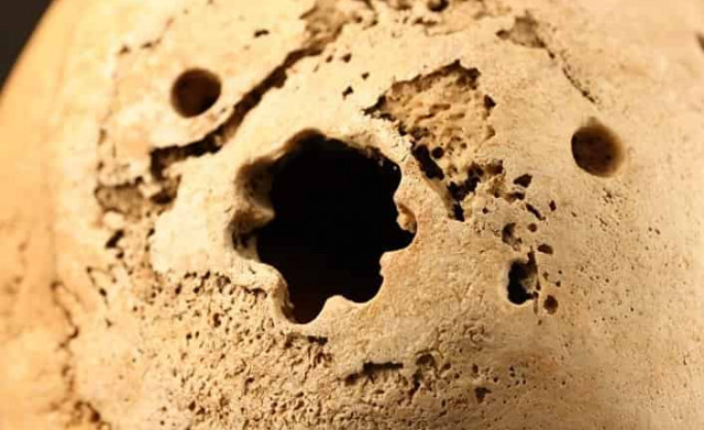 Зачем наши предки проделывали друг другу отверстия в черепе