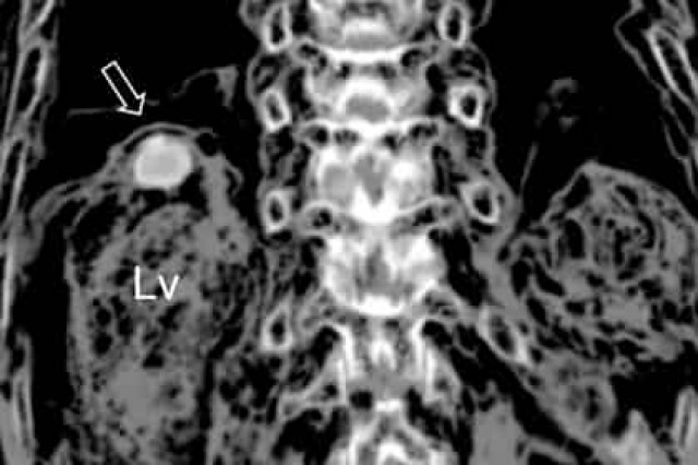 В мумии нашли смертоносных паразитов