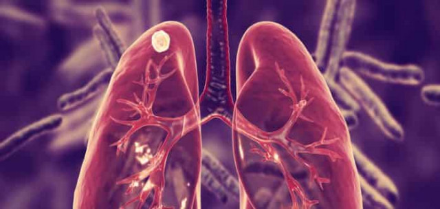 COVID-19 отбросил прогресс в борьбе с туберкулезом